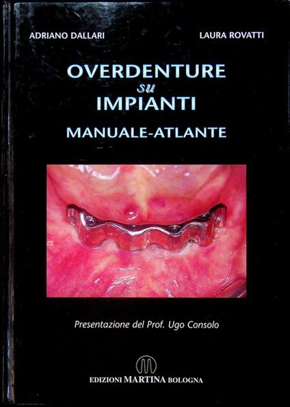 Overdenture su impianti: manuale-atlante. Presentazione del prof. Ugo Consolo - copertina